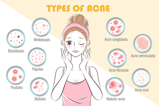 girl with types of acne