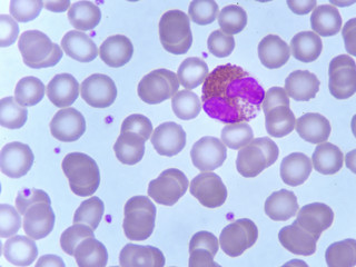 Eosinophil cell in blood smear, analyze by microscope