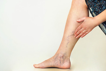 Varicose veins on the womans legs