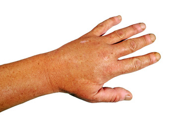 Geschwollene Hand nach dem Stich einer Wespe