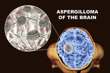 Aspergilloma of the brain and close-up view of fungi Aspergillus, 3D illustration. An intracranial lesion produced by fungi Aspergillus in immunocompromised patients