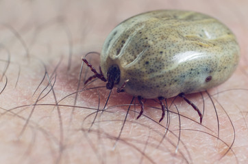 Tick filled with blood sitting on human skin