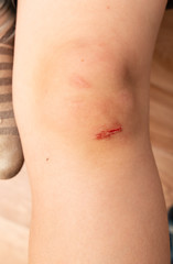 wound on the child's knee