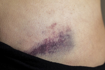 Macro shot of young woman with bruise, hematoma on pelvis