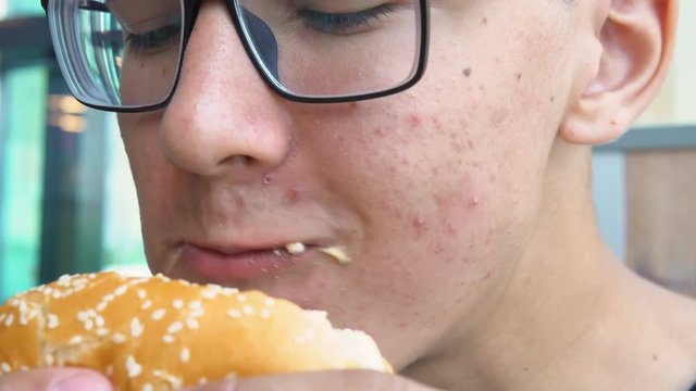 A young man with acne on his face eats hamburger in a fast food restaurant.
