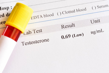 Abnormal low testosterone hormone test result 