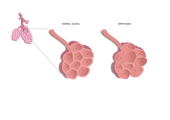 normal, healthy alveoli (lungs) and with emphysema