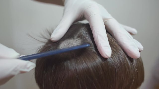 Skin disease. Fungal disease of the scalp. Reception at the doctor. Adaptation. Problems with hair. Lichen.
