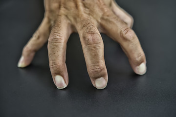 Close Up Of Man Suffering With Parkinsons