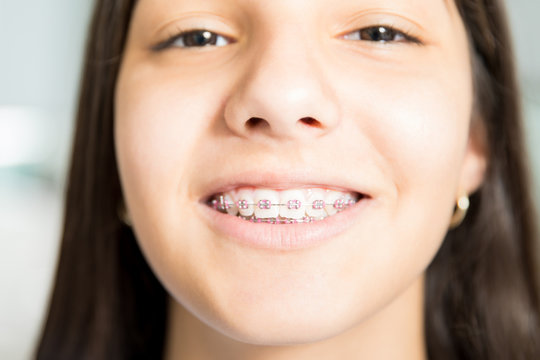 Closeup Of Smiling Teenage Girl With Braces