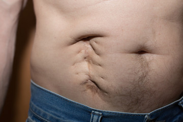 Naklejka premium Ugly bad scar on the man's fat belly after the appendicitis surgery. Old keloid scar on the stomach. Medical treatment disease photo.
