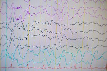 Computer monitor showing electrical activity of abnormal brain,EEG of the pediatric patients with problems in the brain.