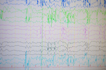 Computer monitor showing electrical activity of abnormal brain,EEG of the pediatric patients with...