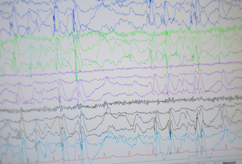 Computer monitor showing electrical activity of abnormal brain,EEG of the pediatric patients with problems in the brain.