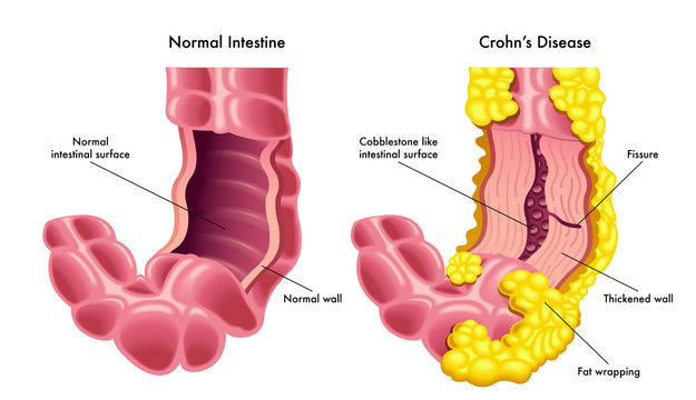 A vector medical illustration of a section of a normal intestine compared to a section of intestine with the symptoms of the Crohn's disease.
