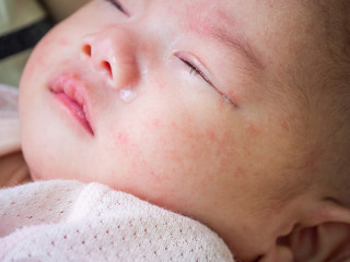 newborn baby with allergy on face