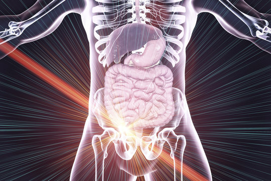 Laser surgery treatment of acute appendicitis, conceptual image, 3D illustration. Appendectomy