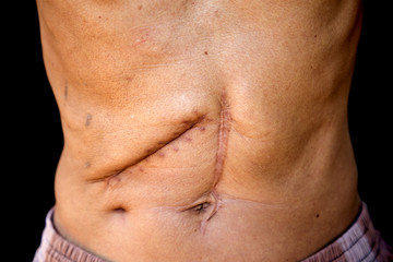 Scars caused by abdominal surgery.