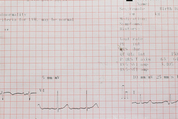Electrocardiogram of wave in paper report analysis. Medical and healthcare concept.