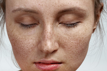 woman with freckles