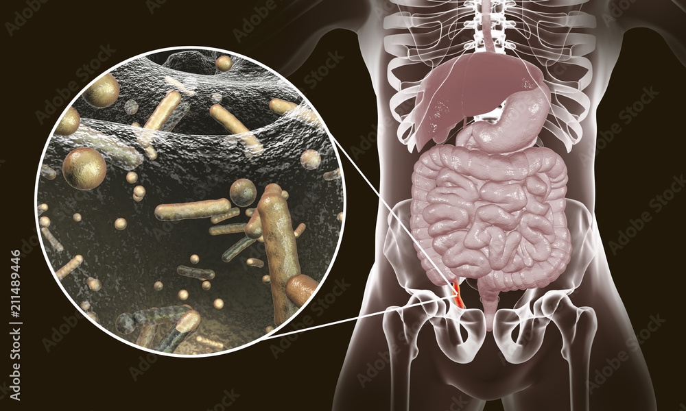 Poster acute appendicitis and close-up view of bacteria in appendix, the causative agent of appendicitis, 3