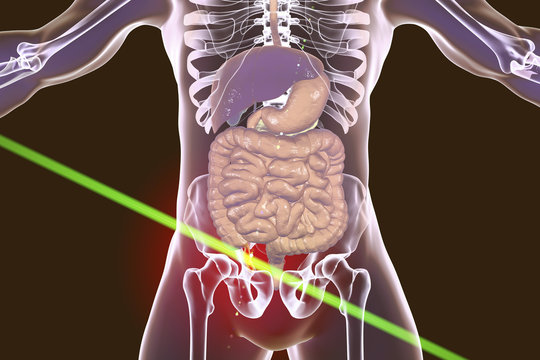 Laser surgery treatment of acute appendicitis, conceptual image, 3D illustration. Appendectomy