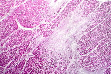 Acute myocardial infarction, histology of heart tissue, light micrograph. Area of infarct is paler than than the relatively viable area of heart muscle