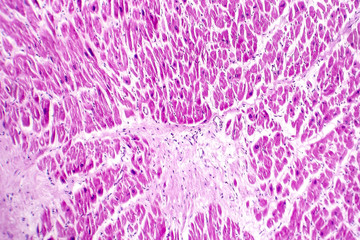 Acute myocardial infarction, histology of heart tissue, light micrograph. Area of infarct is paler than than the relatively viable area of heart muscle