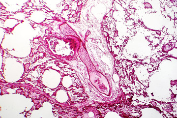 Transparent thrombosis, light micrograph, hematoxylin and eosin staining