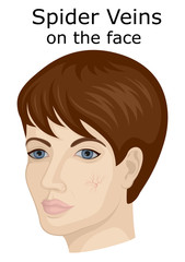 Illustration of the facial spider veins
