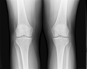 Front knee joint x-ray of mature female with osteoarthritis