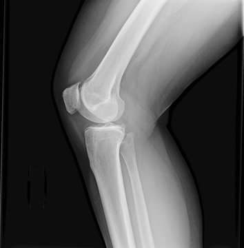Right knee joint x-ray of mature female with osteoarthritis