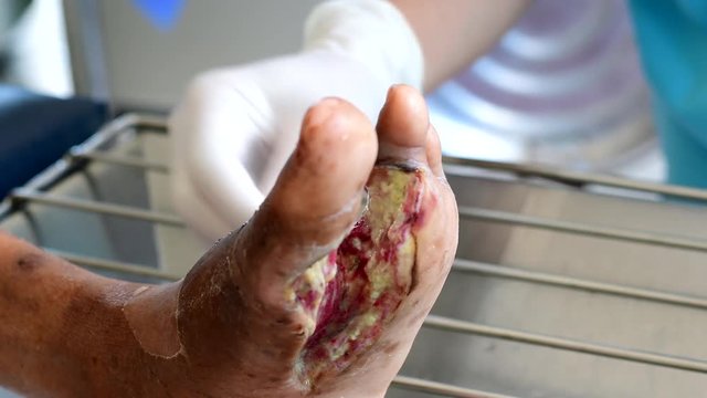 cleaning infected wound on foot 