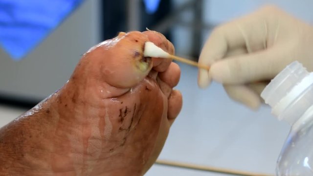 cleaning infected wound on foot 