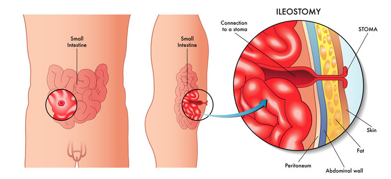 Mature man with stoma wearing transparent ileostomy bag. See image 2ARGPBT  for new, empty bag after changing Stock Photo - Alamy