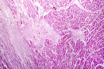 Acute myocardial infarction, histology of heart tissue, light micrograph. Area of infarct is paler than than the relatively viable area of heart muscle