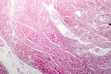 Histopathology of bacterial myocarditis, inflammatory heart disease, light micrograph