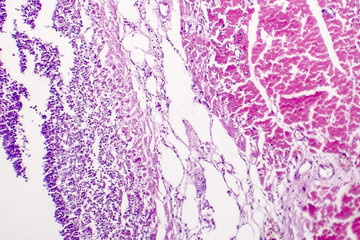 Fototapeta premium Histopathology of bacterial myocarditis, inflammatory heart disease, light micrograph