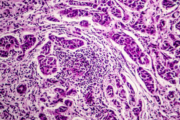 Lymph node metastasis, light micrograph of cancer that has spread to a lymph node