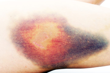 Bruise on white skin. Close-up photo