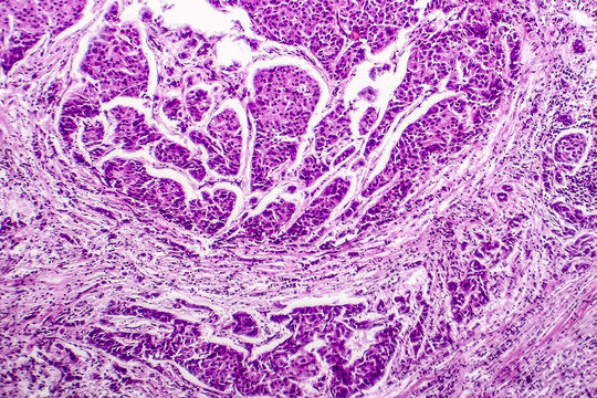 Lymph node metastasis, light micrograph of cancer that has spread to a lymph node