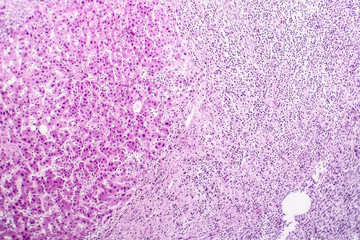 Histopathology of liver abscess, light micrograph, hematoxylin and eosin staining