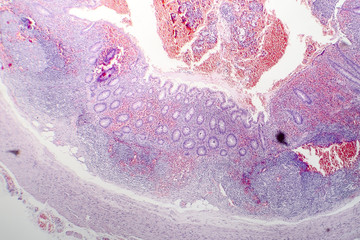 Histopathology of chronic appendicitis, light micrograph, photo under microscope