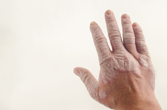 Exacerbation of psoriasis in the hands. Concept of health