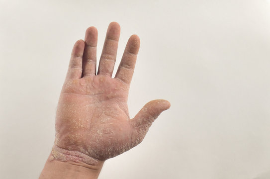 Exacerbation of psoriasis in the hands. Concept of health