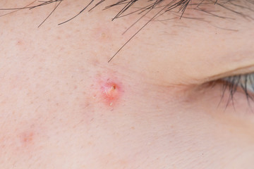 close up of facial acne