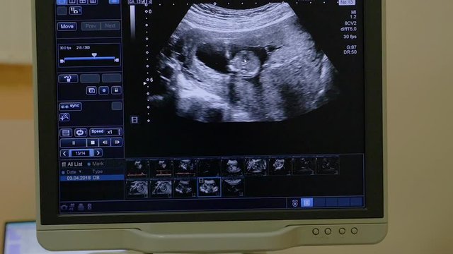 Ultrasound sonogram pregnancy scan screen of 2nd trimester baby fetus