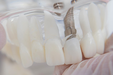 Fototapeta na wymiar A model of teeth with implants lies on a table