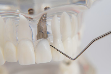 Fototapeta na wymiar A model of teeth with implants lies on a table
