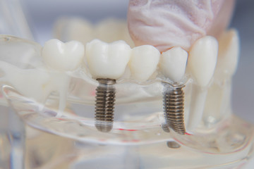 Fototapeta na wymiar Orthodontist shows how to insert the implant. Macro